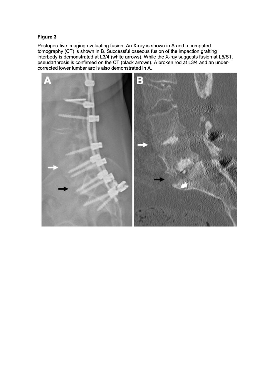 Figure 1 for Fusion and Revision Rates of Impaction Grafting Interbody Fusion Comparing X-Rays and Computed Tomography