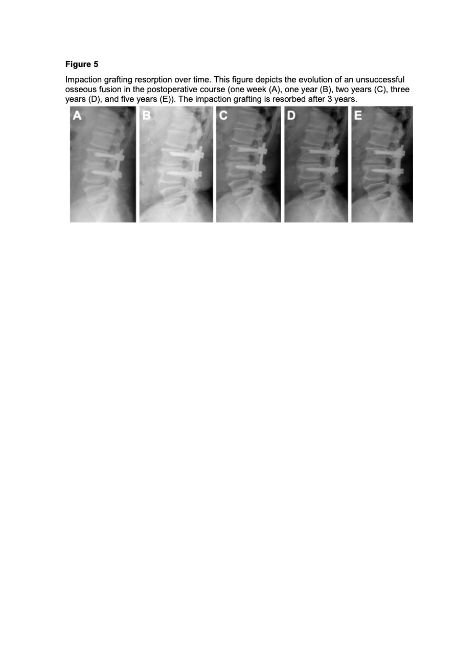 Figure 3 for Fusion and Revision Rates of Impaction Grafting Interbody Fusion Comparing X-Rays and Computed Tomography