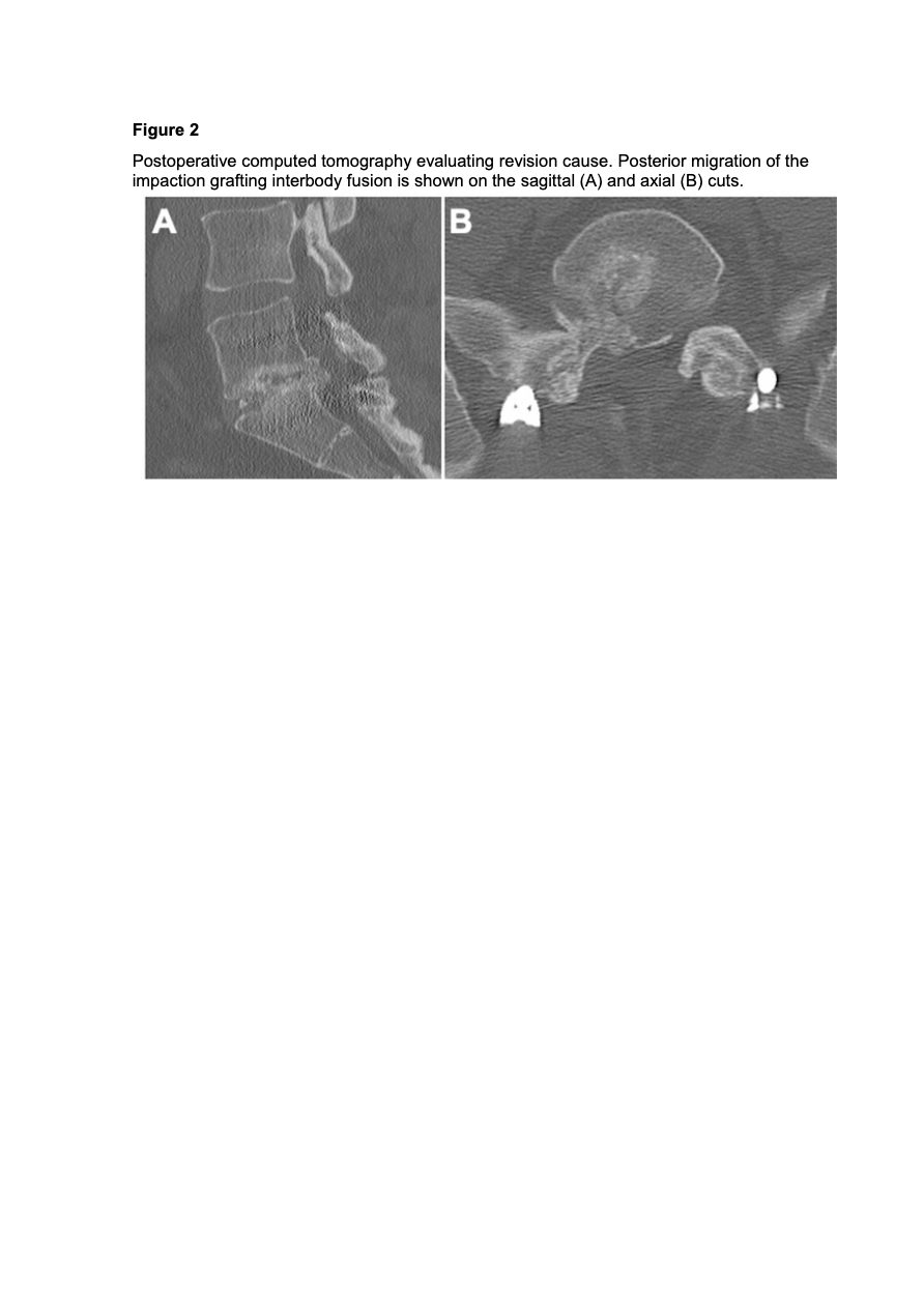Figure 4 for Fusion and Revision Rates of Impaction Grafting Interbody Fusion Comparing X-Rays and Computed Tomography