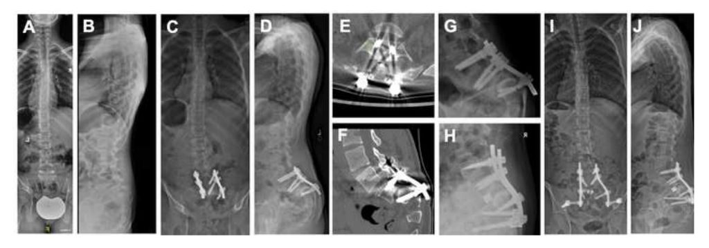 Figure 1 from Use of a Metal Cutting Wheel Burr and Osteotome as a Screwdriver to Remove Imbedded Broken Pedicle Screws in the Revision of a High Grade Spondylolisthesis