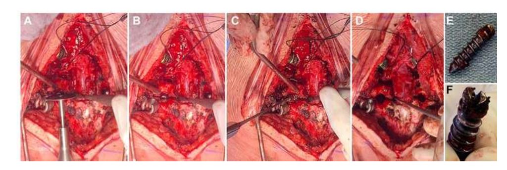 Figure 2 from Use of a Metal Cutting Wheel Burr and Osteotome as a Screwdriver to Remove Imbedded Broken Pedicle Screws in the Revision of a High Grade Spondylolisthesis