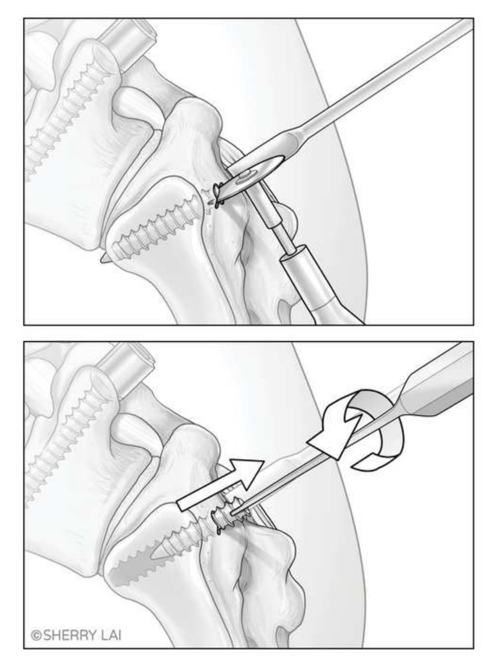 Figure 3 from Use of a Metal Cutting Wheel Burr and Osteotome as a Screwdriver to Remove Imbedded Broken Pedicle Screws in the Revision of a High Grade Spondylolisthesis